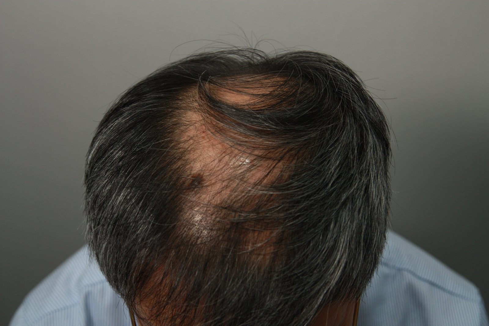 Crown transplant before, MONARA Dermatology Clinic