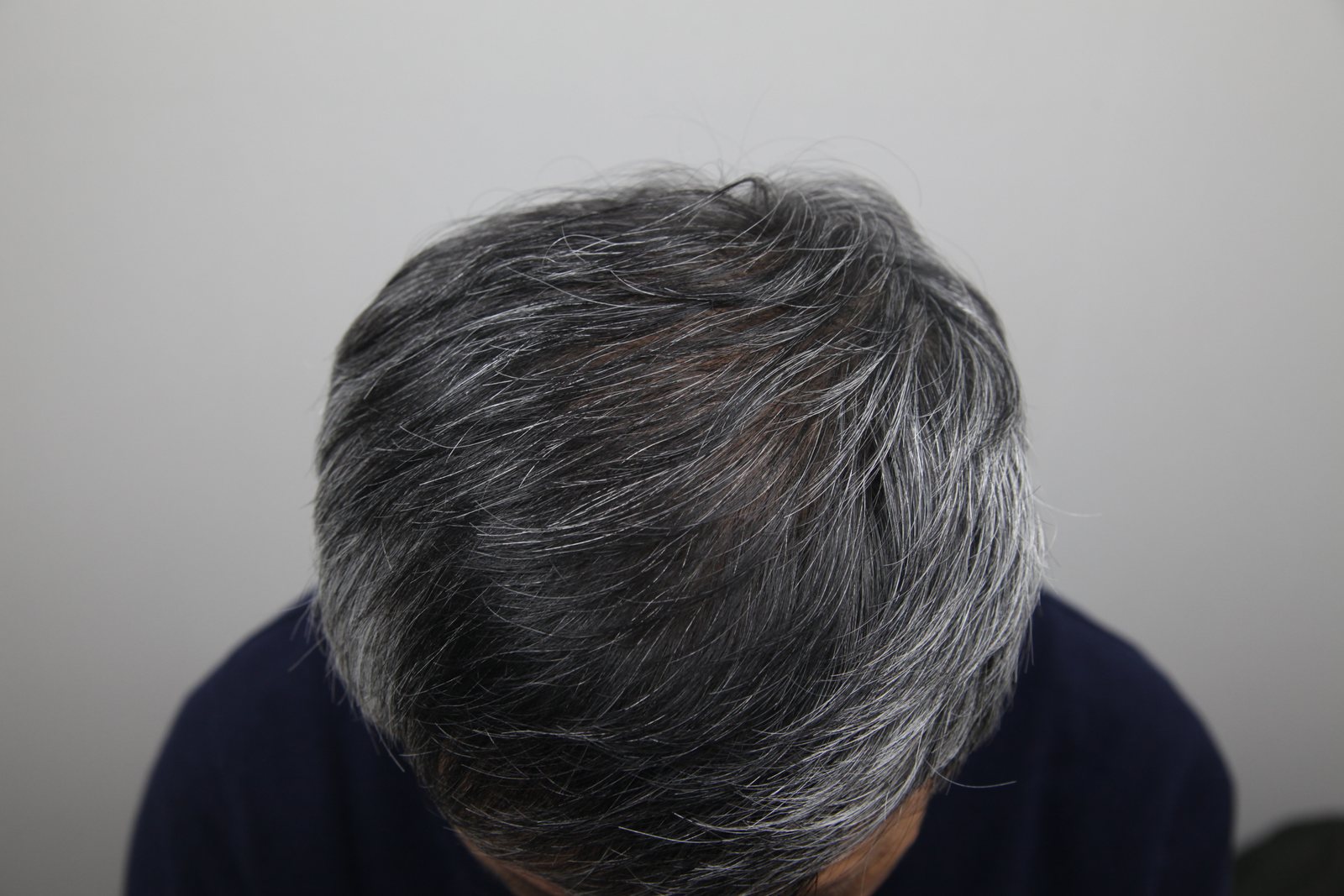 Crown Hair Transplant at MONARA Dermatology Clinic — after, case 2