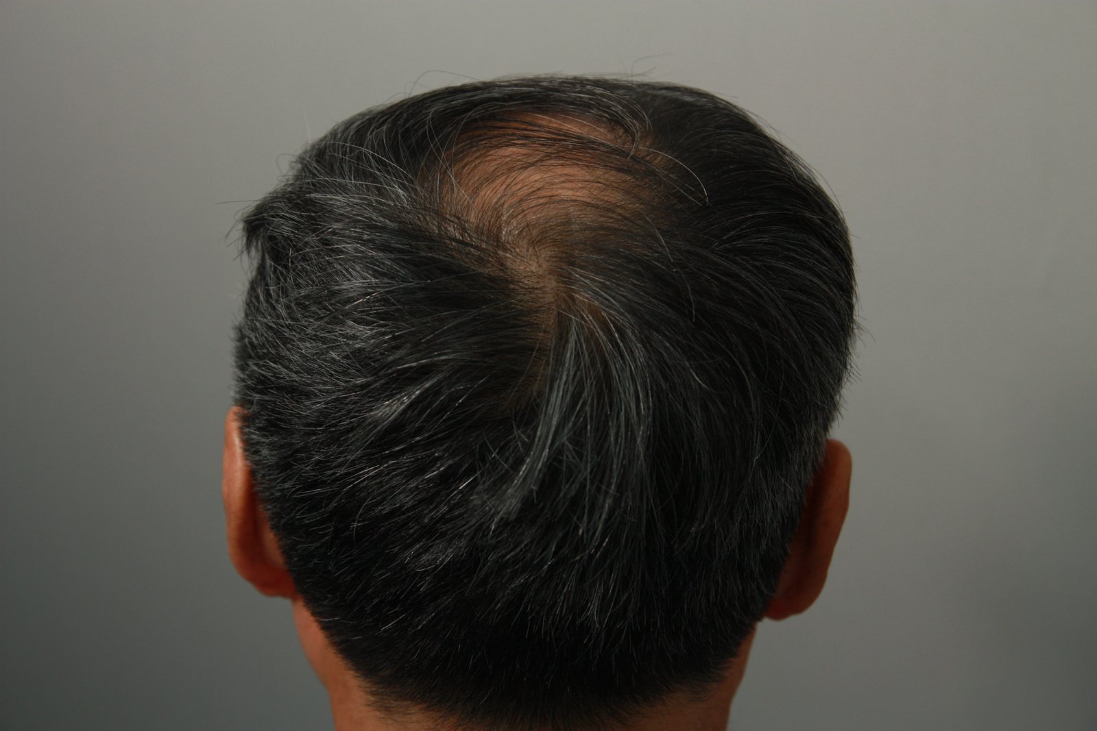 Crown Hair Transplant at MONARA Dermatology Clinic — before, case 2