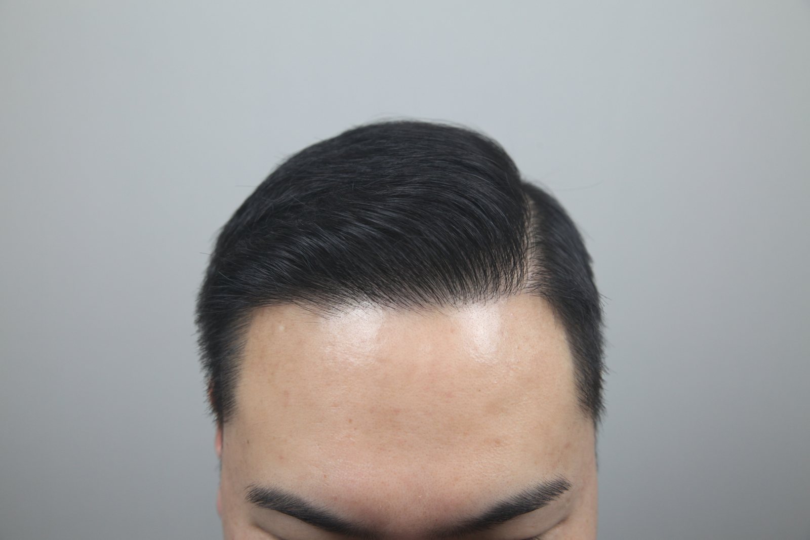 Crown Hair Transplant at MONARA Dermatology Clinic — after, case 3