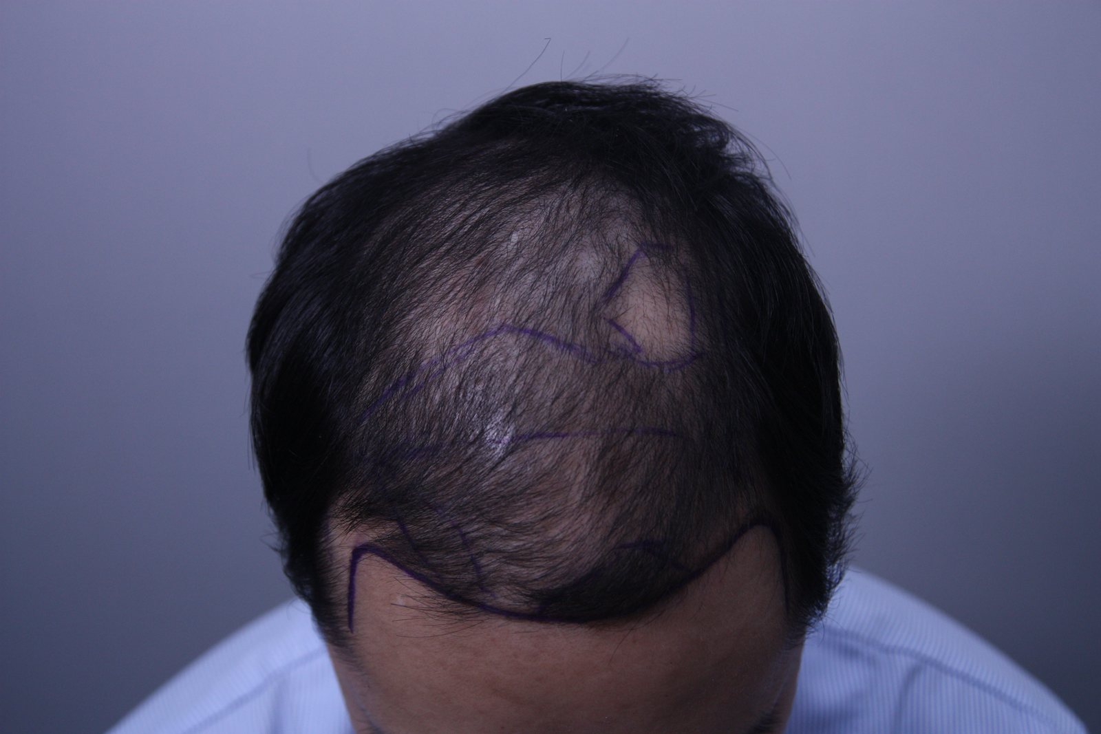 Crown Hair Transplant at MONARA Dermatology Clinic — before, case 3
