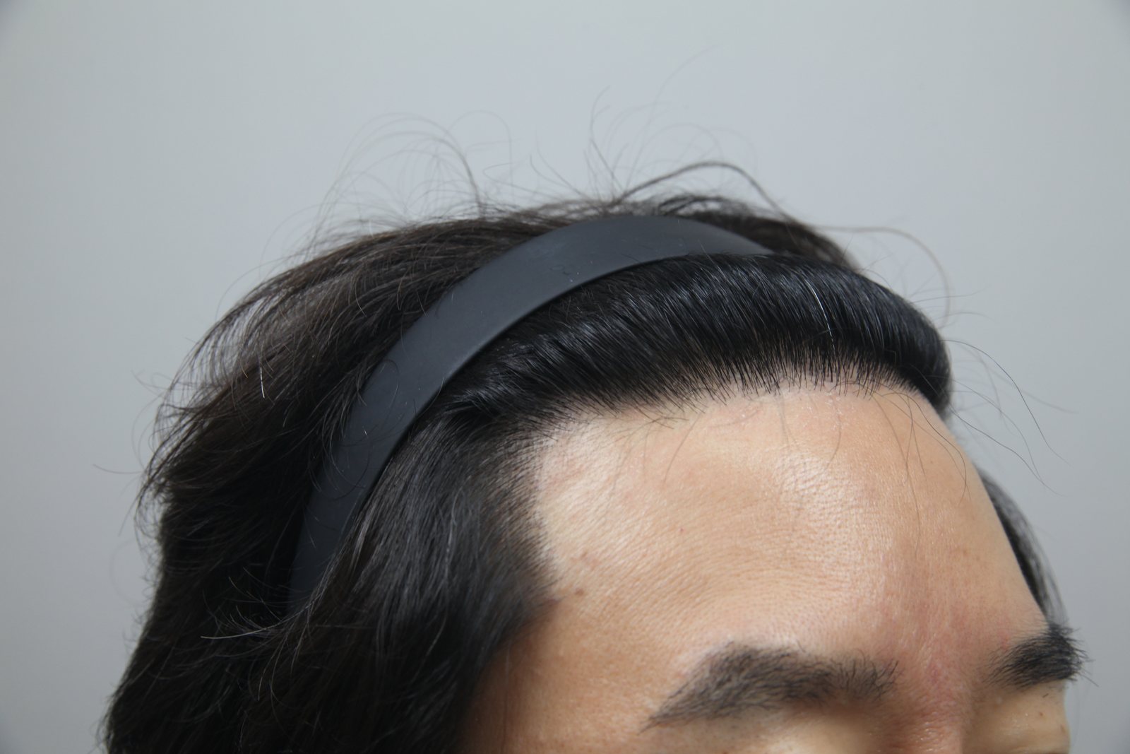 Eyebrow, Beard & Sideburn Transplant at MONARA Dermatology Clinic — after, case 1