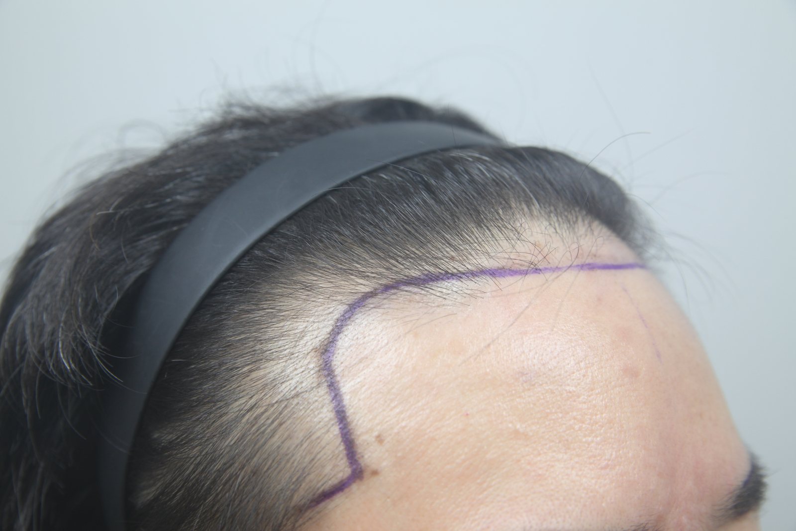 Eyebrow, Beard & Sideburn Transplant at MONARA Dermatology Clinic — before, case 1