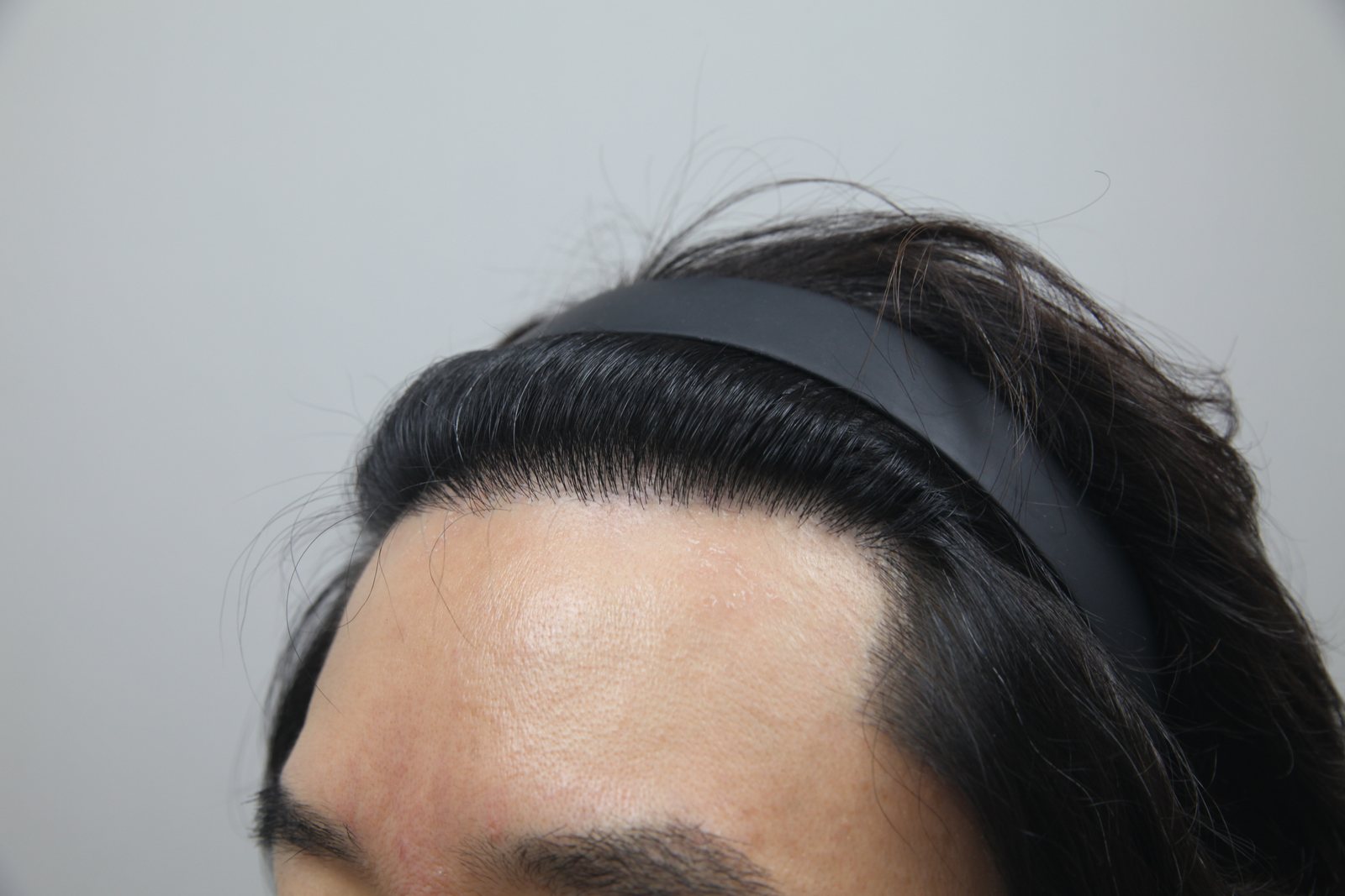 Eyebrow, Beard & Sideburn Transplant at MONARA Dermatology Clinic — after, case 2