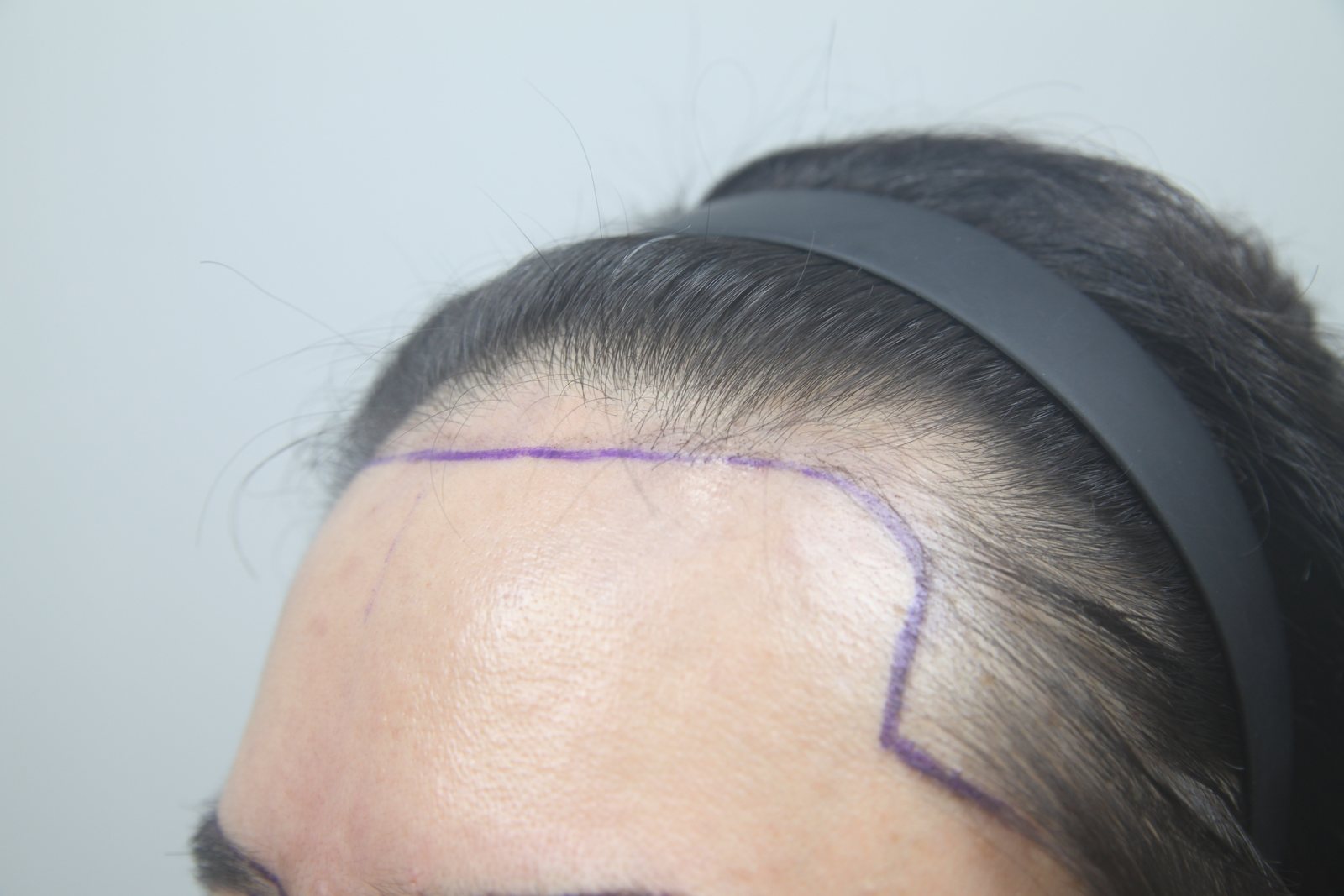 Eyebrow, Beard & Sideburn Transplant at MONARA Dermatology Clinic — before, case 2