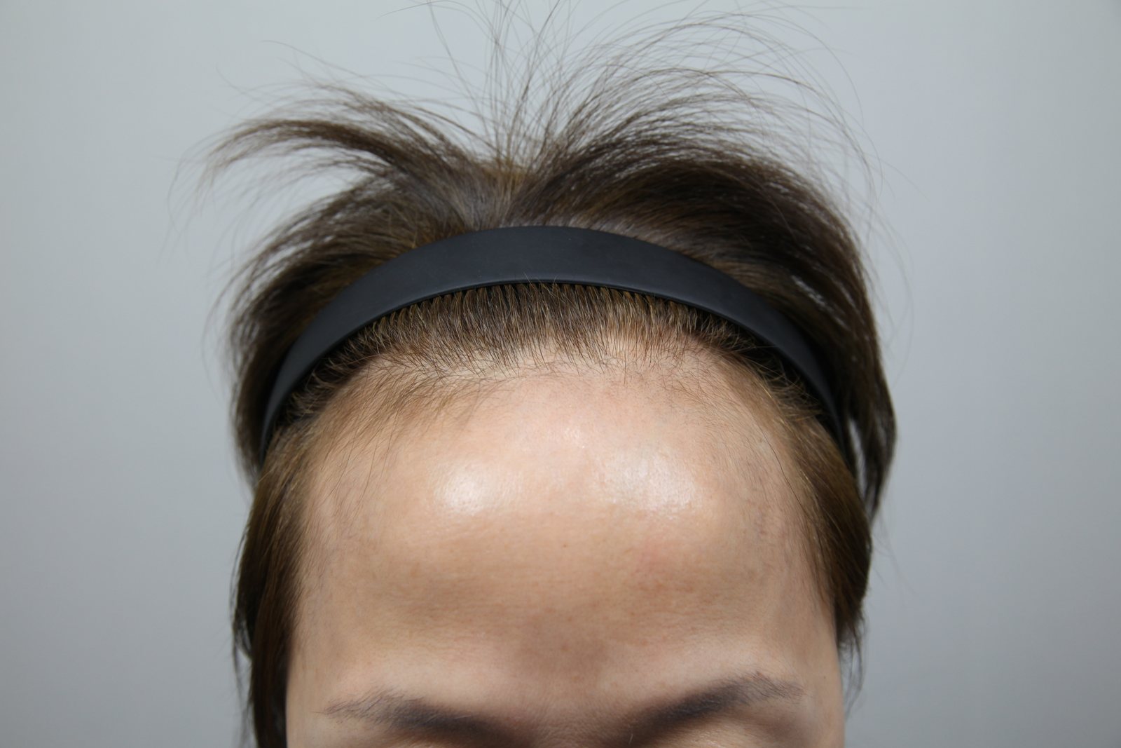 Female hairline before, MONARA Dermatology Clinic
