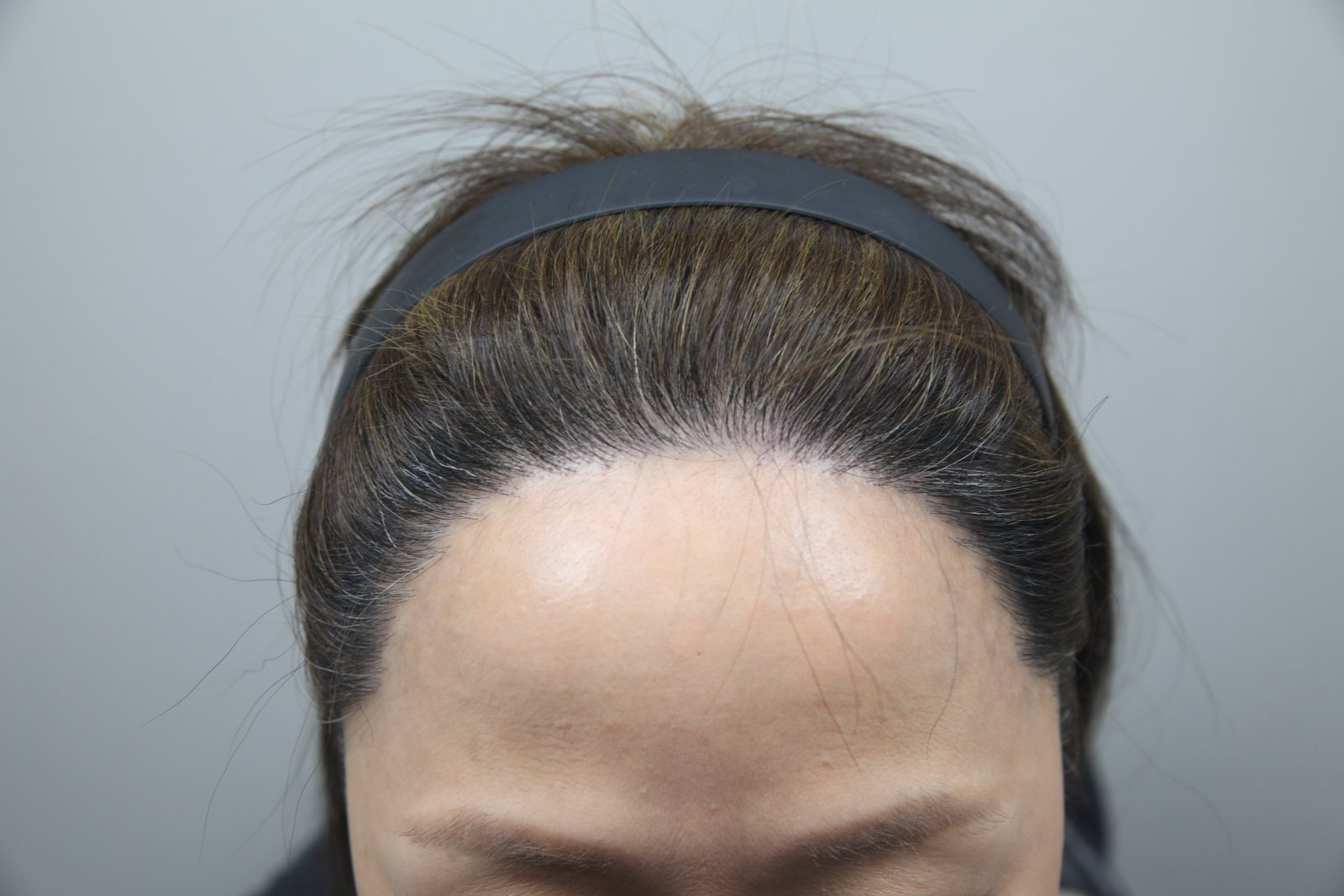 Female Hairline Transplant at MONARA Dermatology Clinic — after, case 2