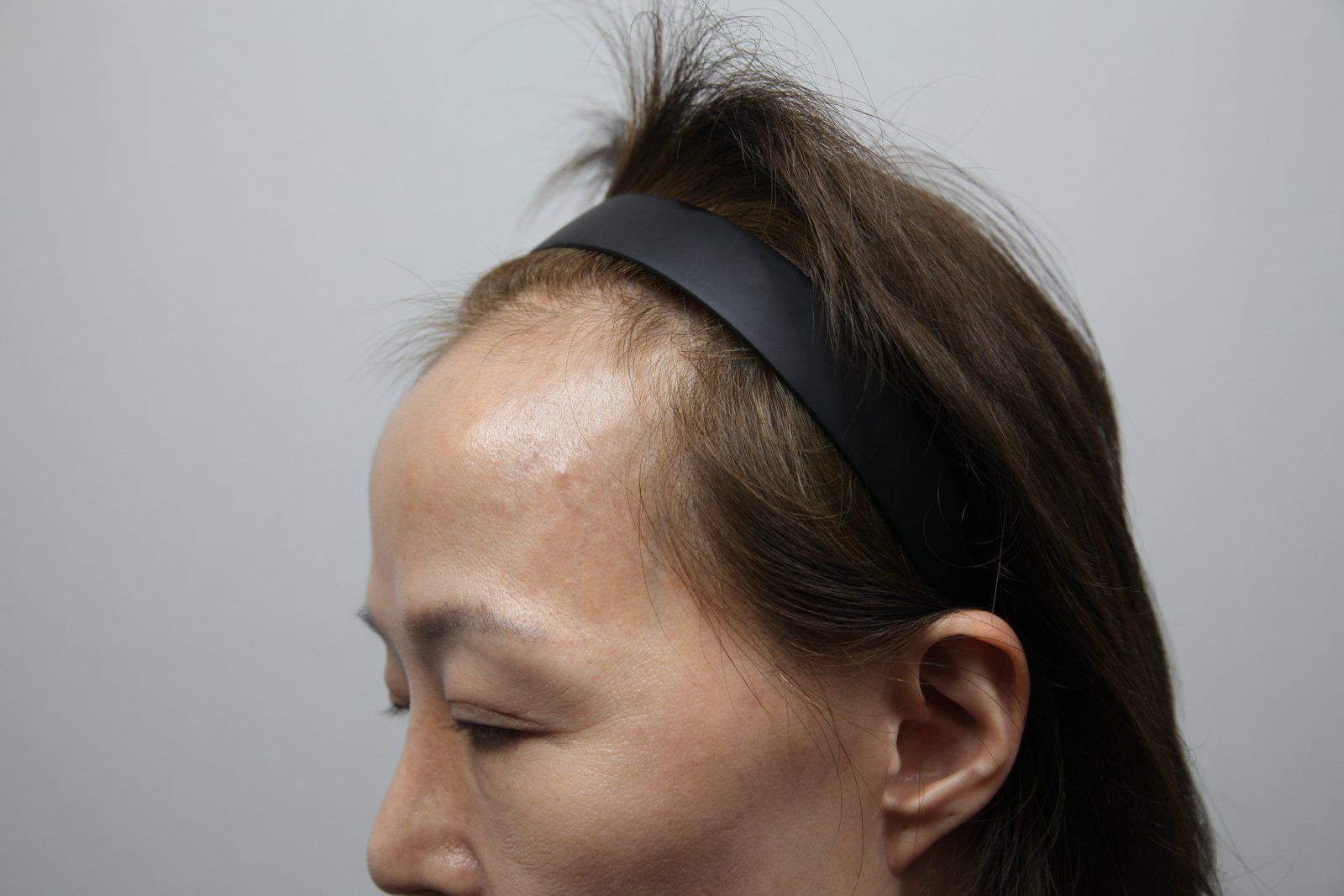 Female Hairline Transplant at MONARA Dermatology Clinic — before, case 2