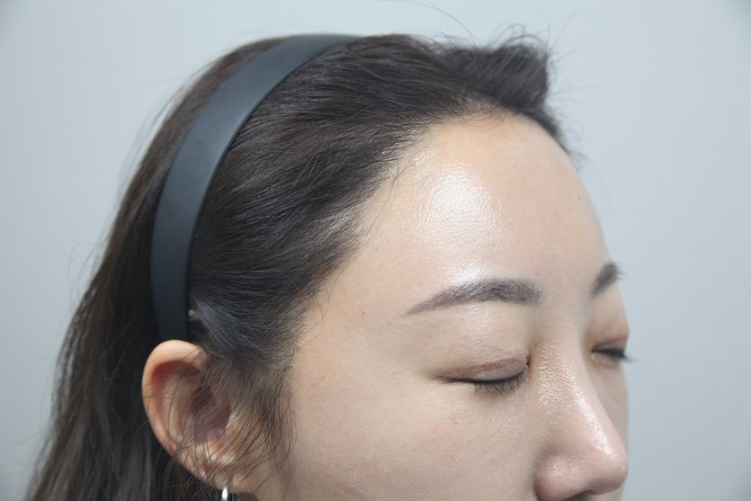 Female Hairline Transplant at MONARA Dermatology Clinic — after, case 3
