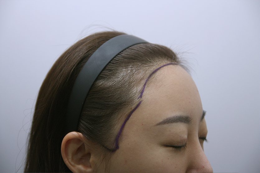 Female Hairline Transplant at MONARA Dermatology Clinic — before, case 3