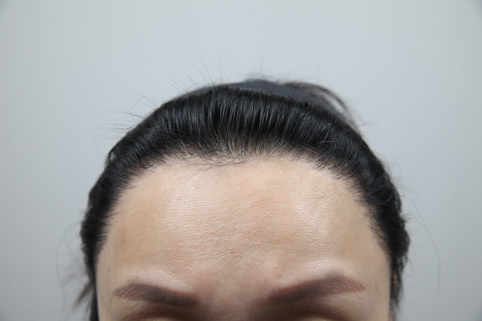 Female Hairline Transplant at MONARA Dermatology Clinic — after, case 4