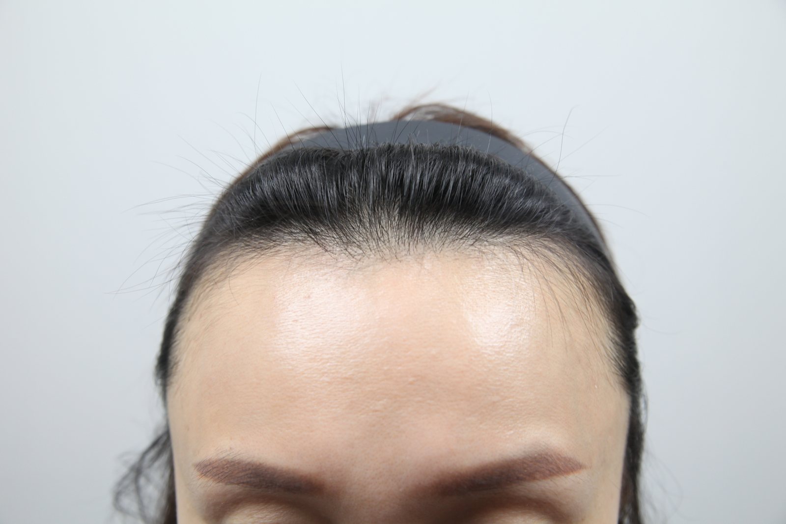 Female Hairline Transplant at MONARA Dermatology Clinic — before, case 4
