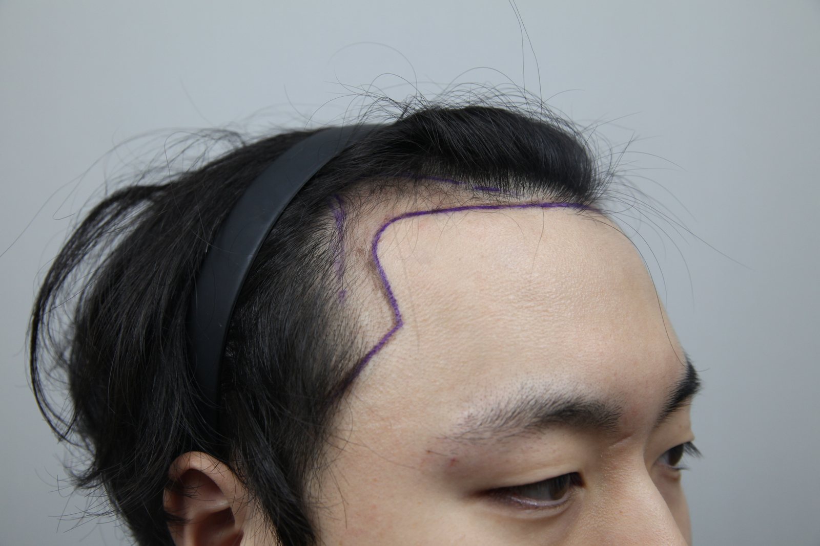 FUE hair transplant before, MONARA Dermatology Clinic