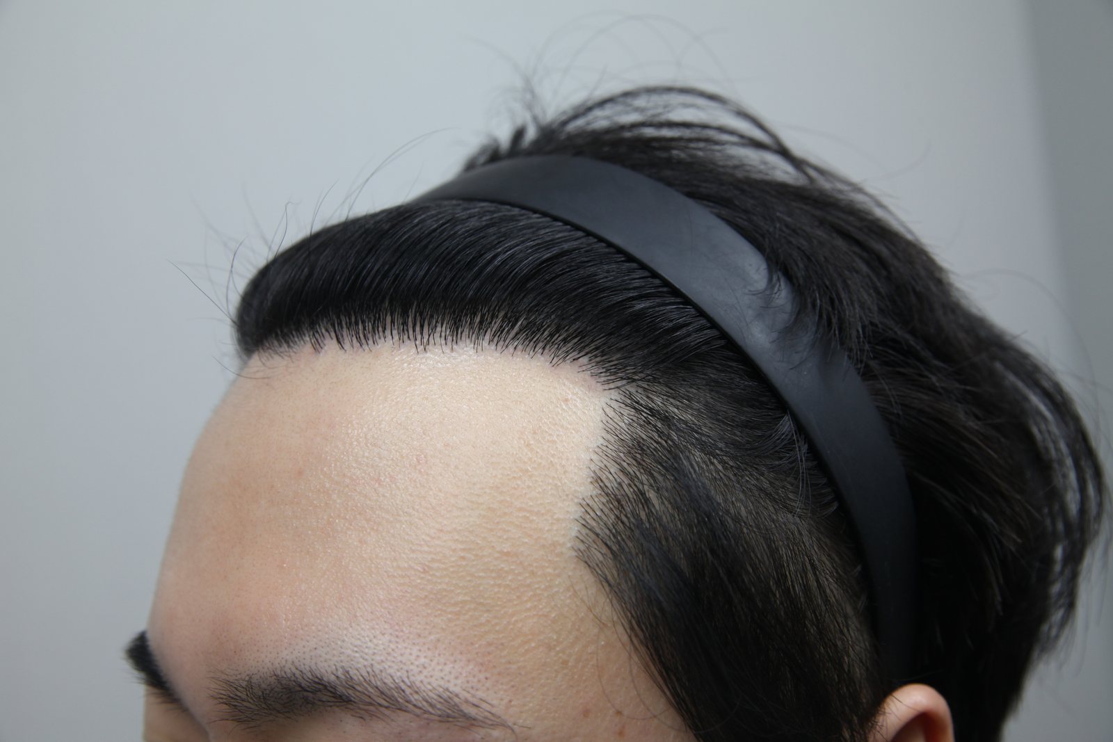 FUE Hair Transplant at MONARA Dermatology Clinic — after, case 2