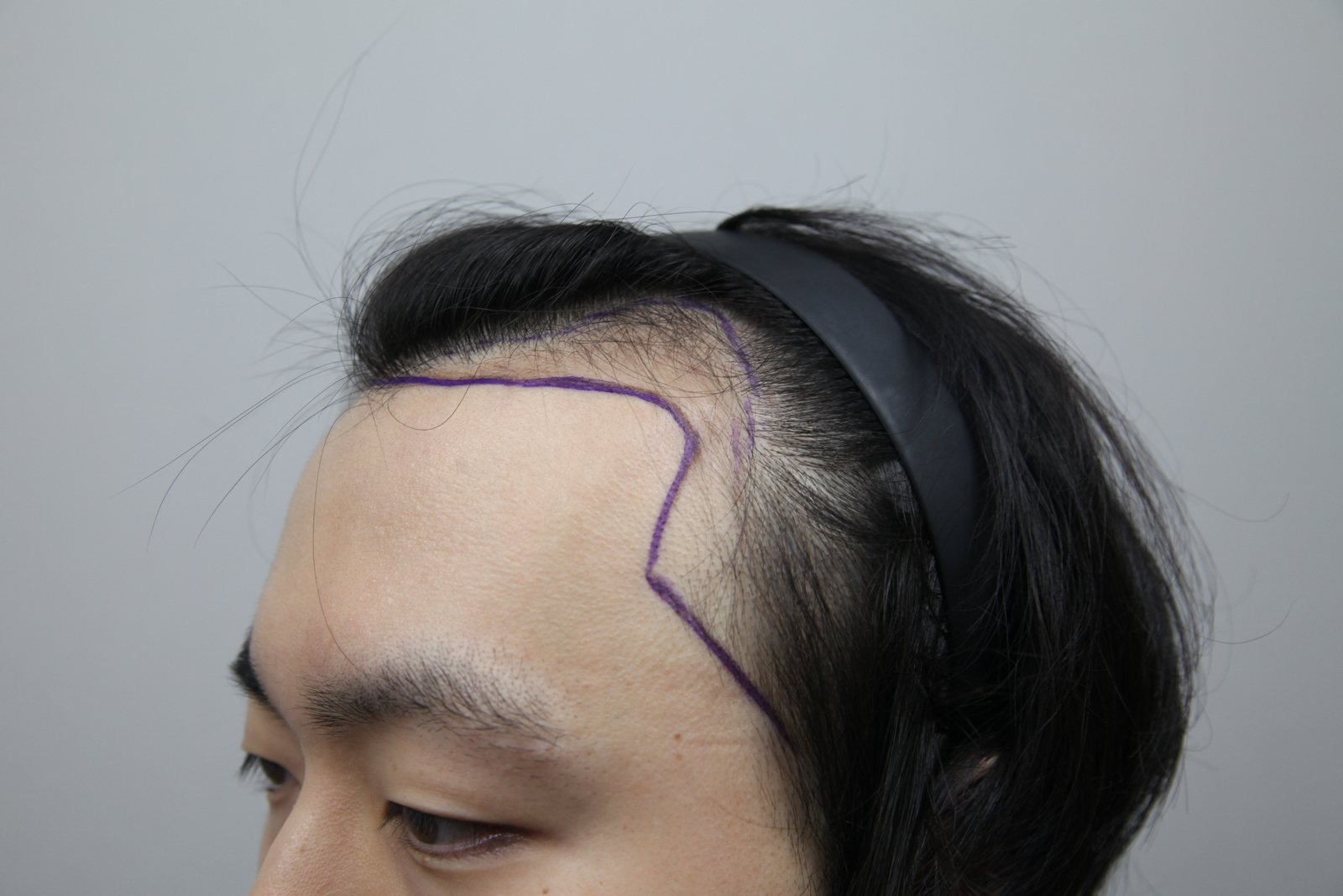 FUE Hair Transplant at MONARA Dermatology Clinic — before, case 2