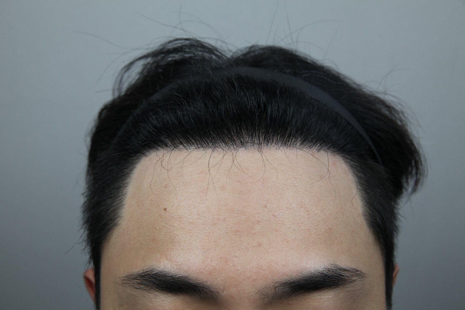 FUE Hair Transplant at MONARA Dermatology Clinic — after, case 3