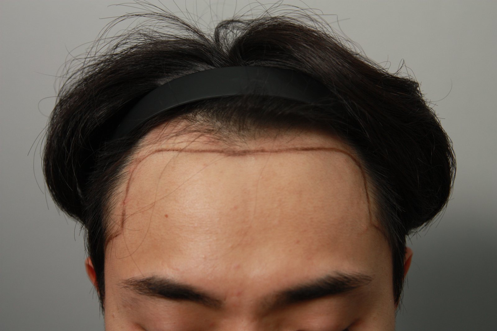 FUE Hair Transplant at MONARA Dermatology Clinic — before, case 3