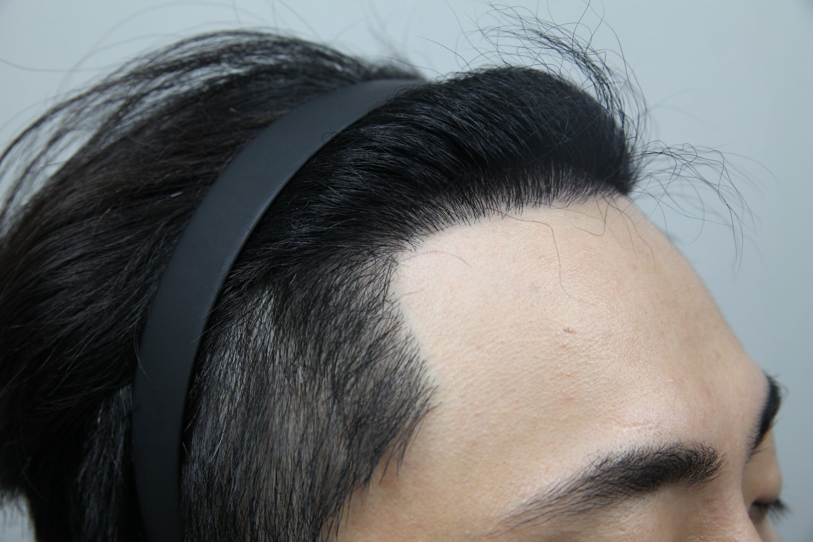 FUE Hair Transplant at MONARA Dermatology Clinic — after, case 4