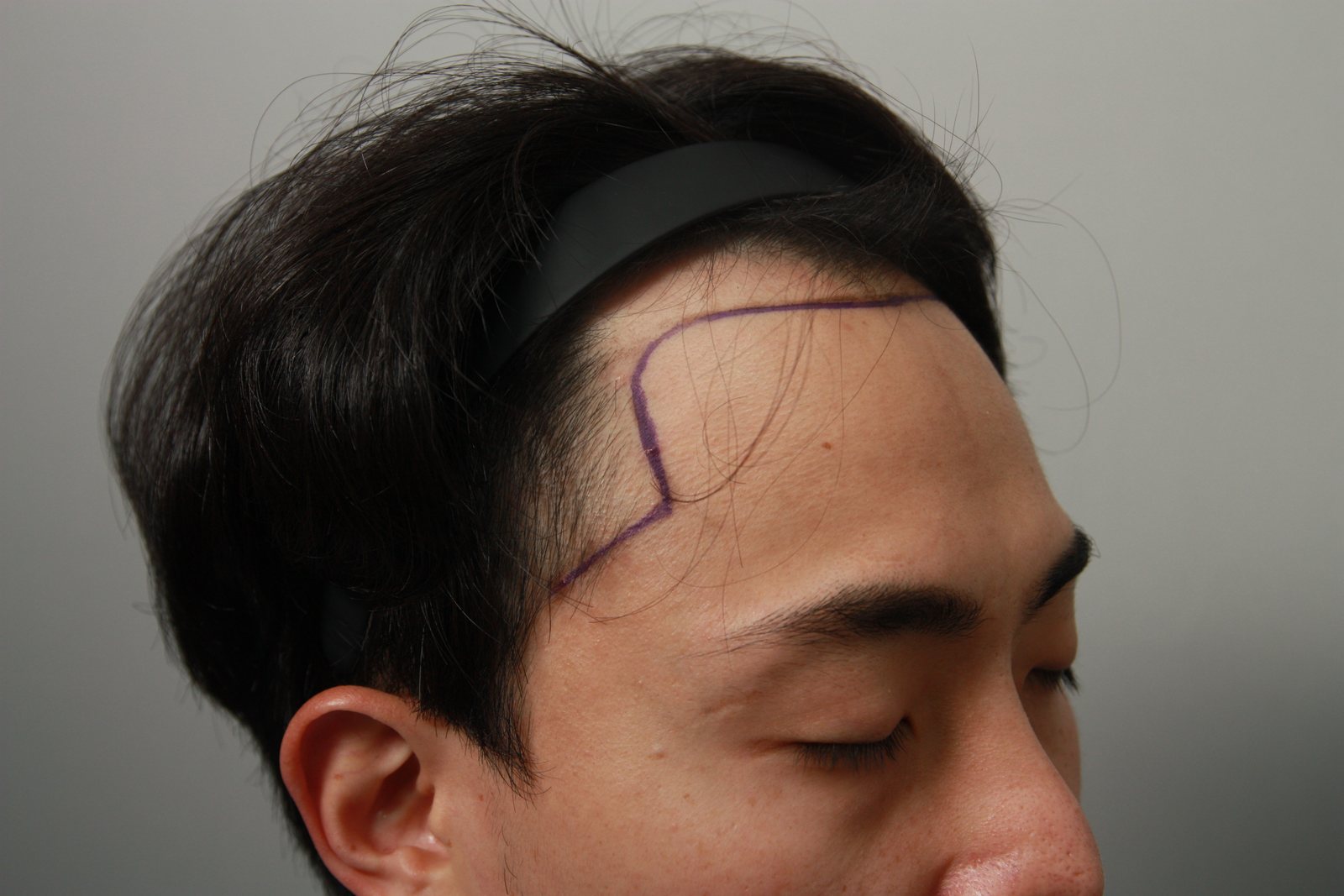 FUE Hair Transplant at MONARA Dermatology Clinic — before, case 4