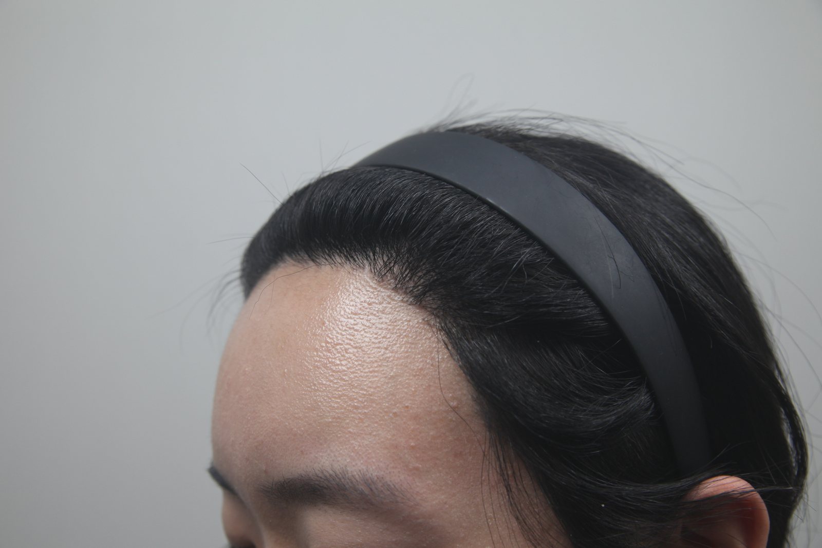 High-Density Hair Transplant at MONARA Dermatology Clinic — after, case 1