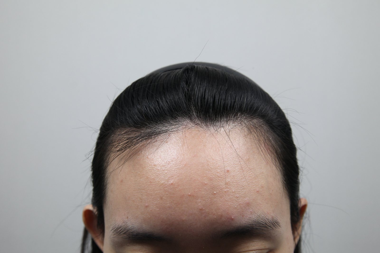 High-Density Hair Transplant at MONARA Dermatology Clinic — before, case 1