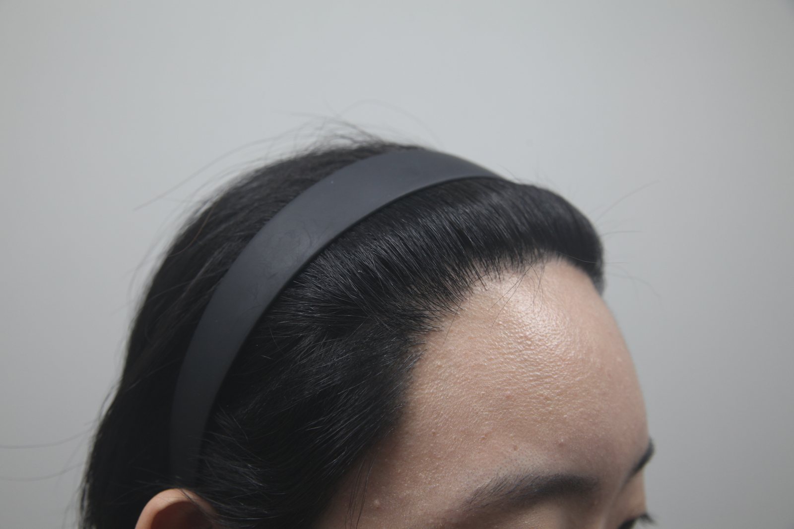High-Density Hair Transplant at MONARA Dermatology Clinic — after, case 2