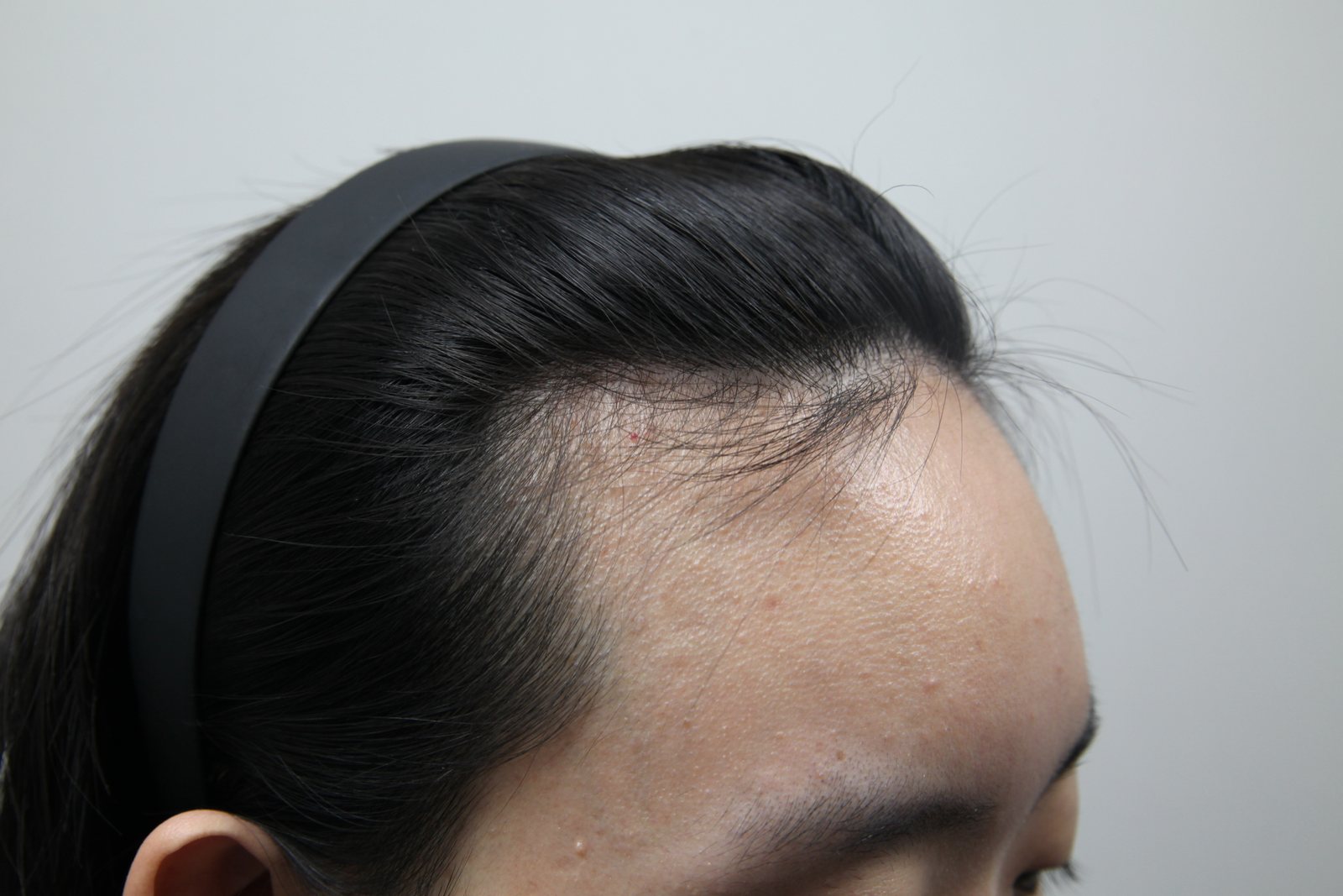 High-Density Hair Transplant at MONARA Dermatology Clinic — before, case 2