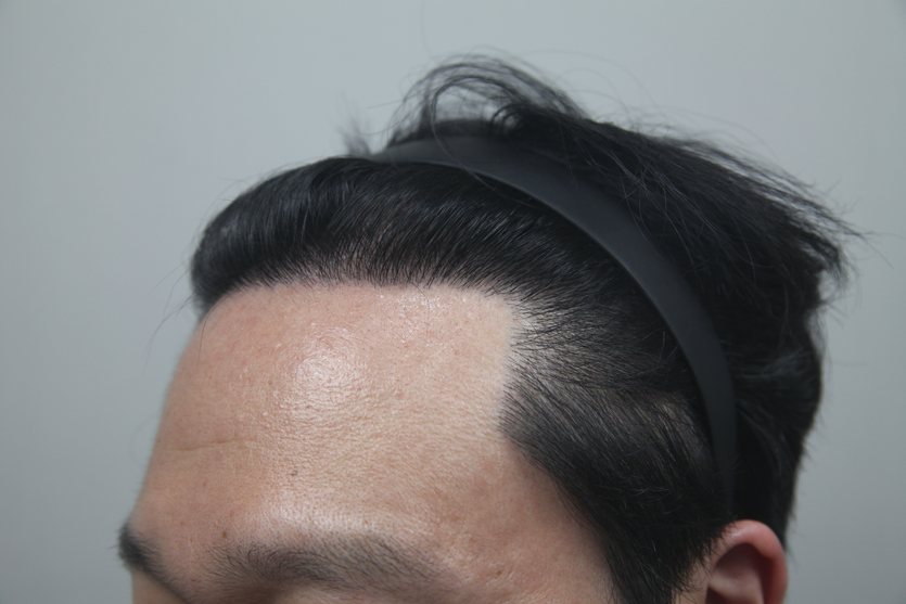 Mega-Session & Body Hair Transplant at MONARA Dermatology Clinic — after, case 1