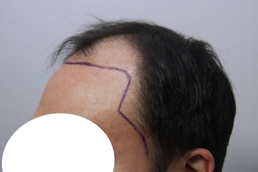 Mega-Session & Body Hair Transplant at MONARA Dermatology Clinic — before, case 1