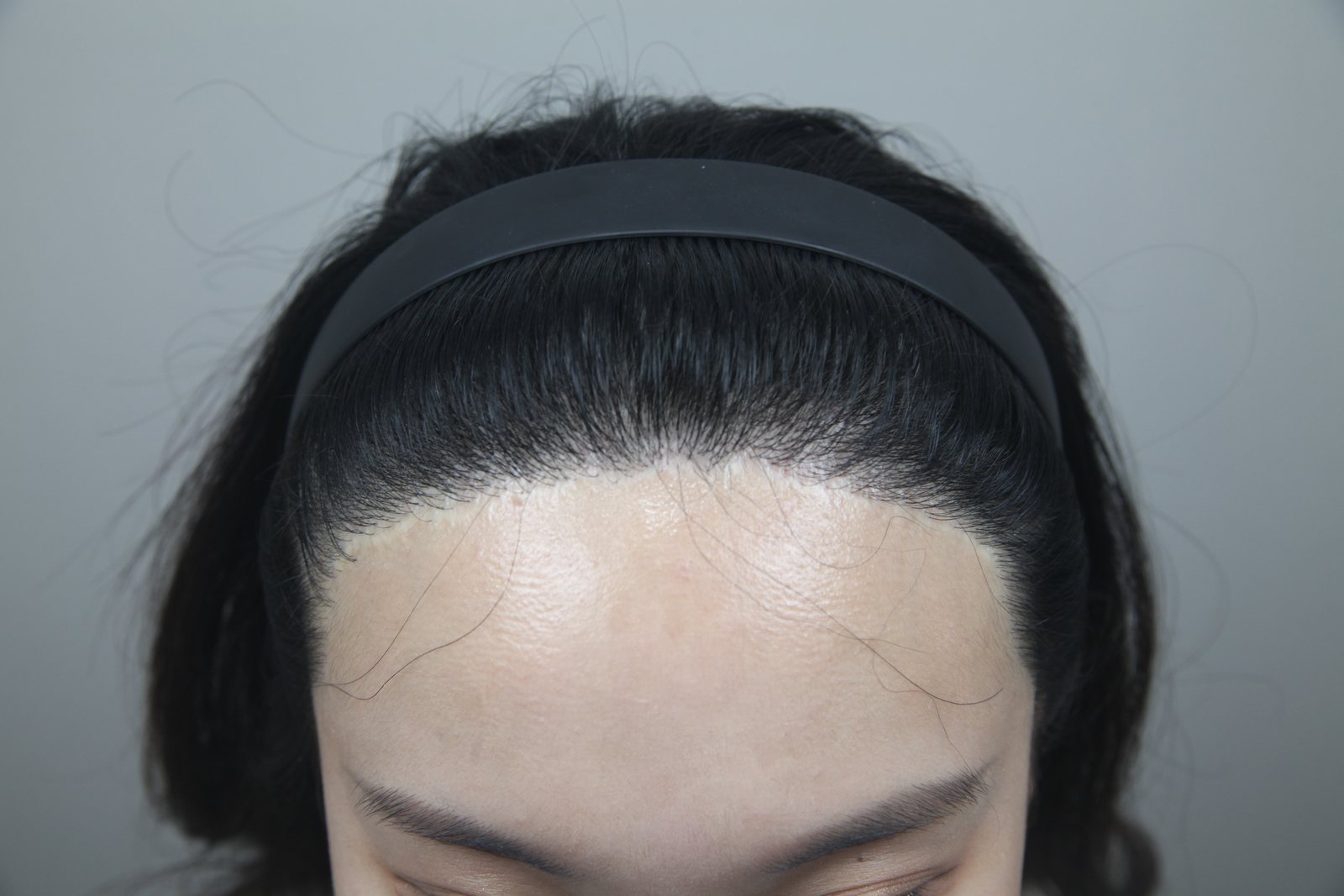 Non-Shaven FUE at MONARA Dermatology Clinic — after, case 1