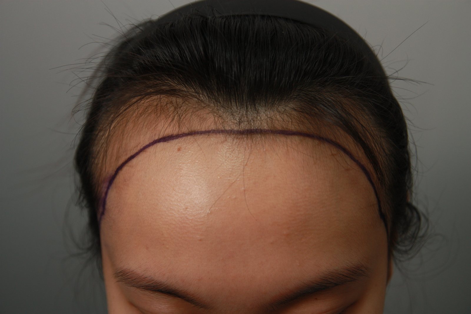 Non-Shaven FUE at MONARA Dermatology Clinic — before, case 1