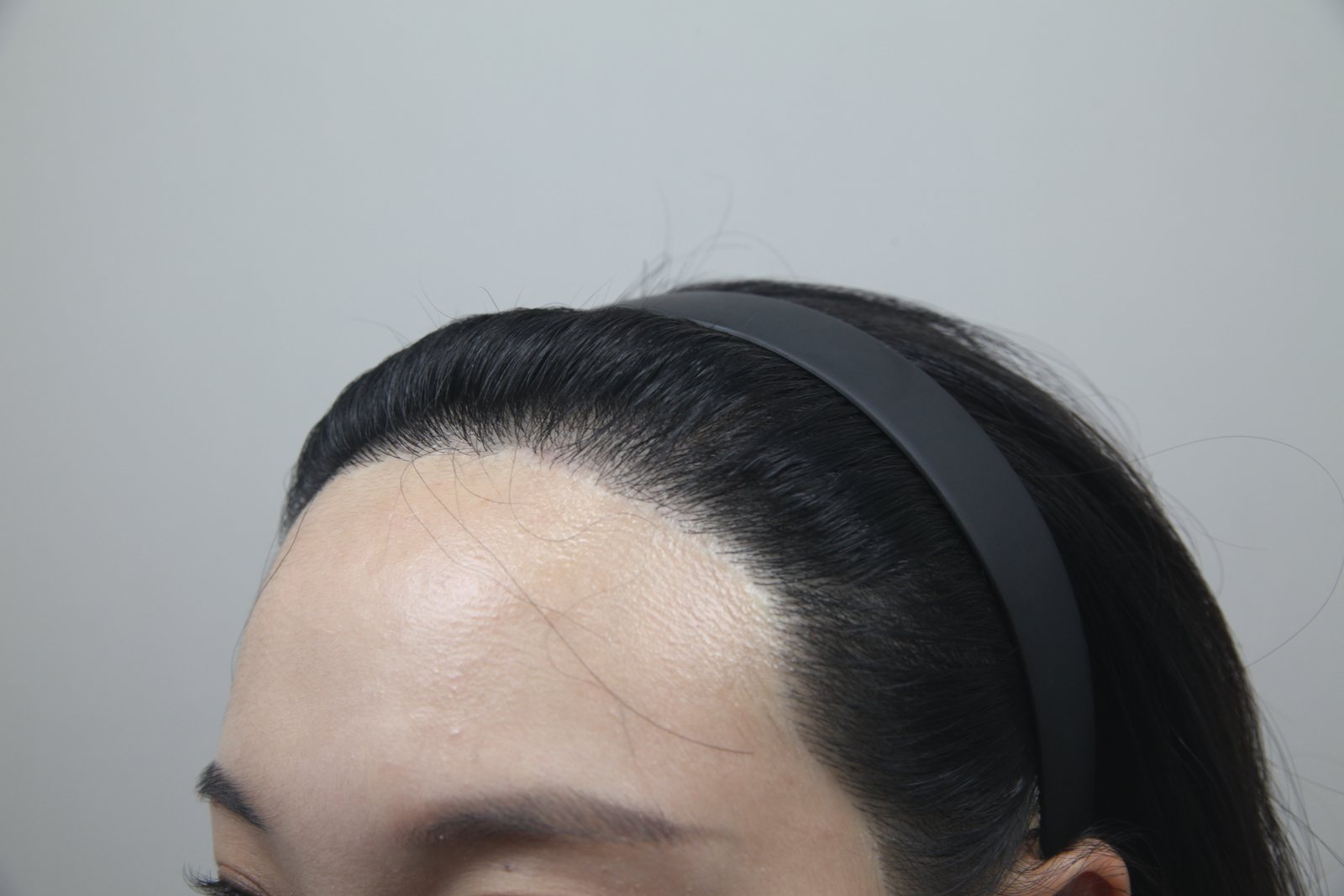 Non-Shaven FUE at MONARA Dermatology Clinic — after, case 2