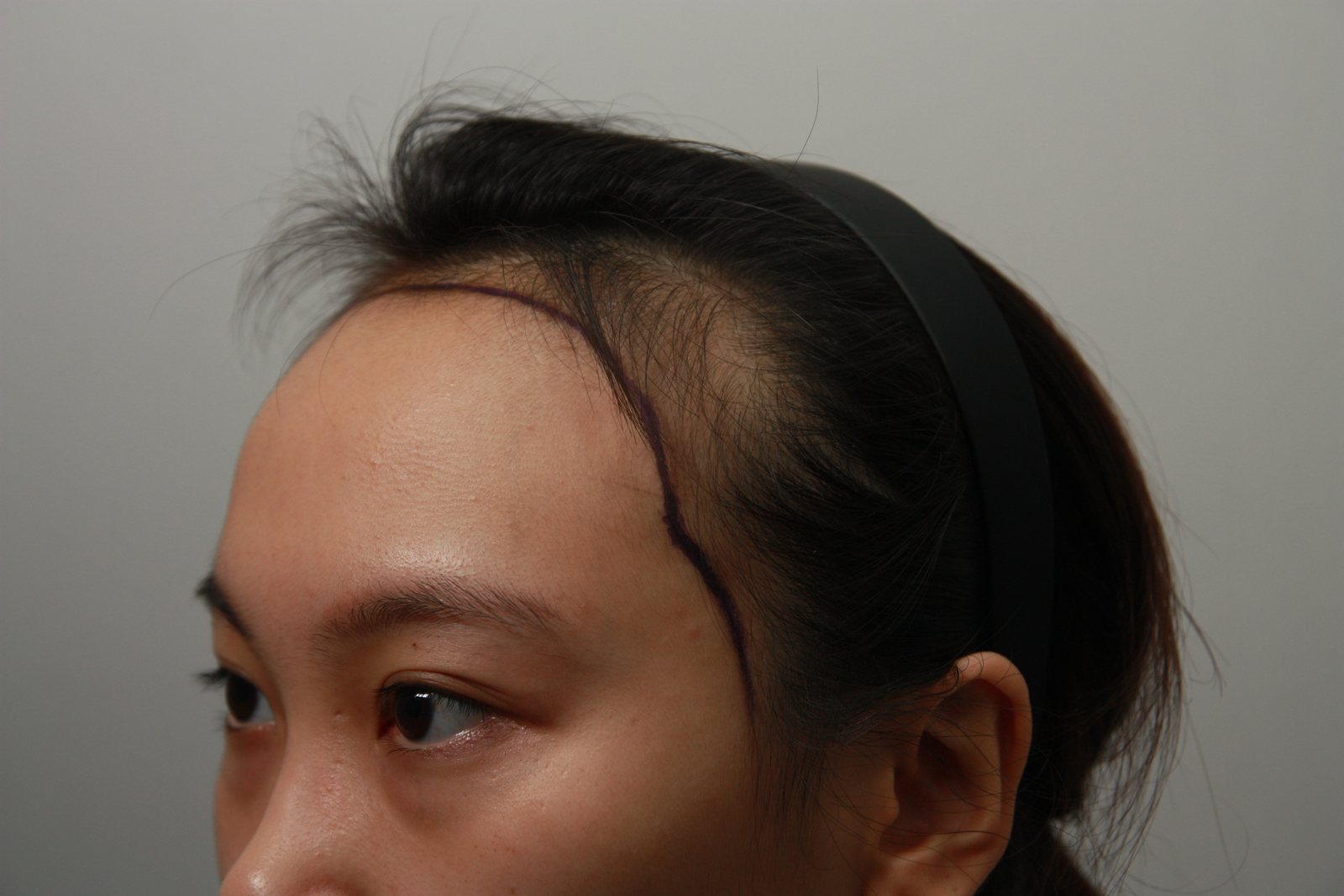 Non-Shaven FUE at MONARA Dermatology Clinic — before, case 2