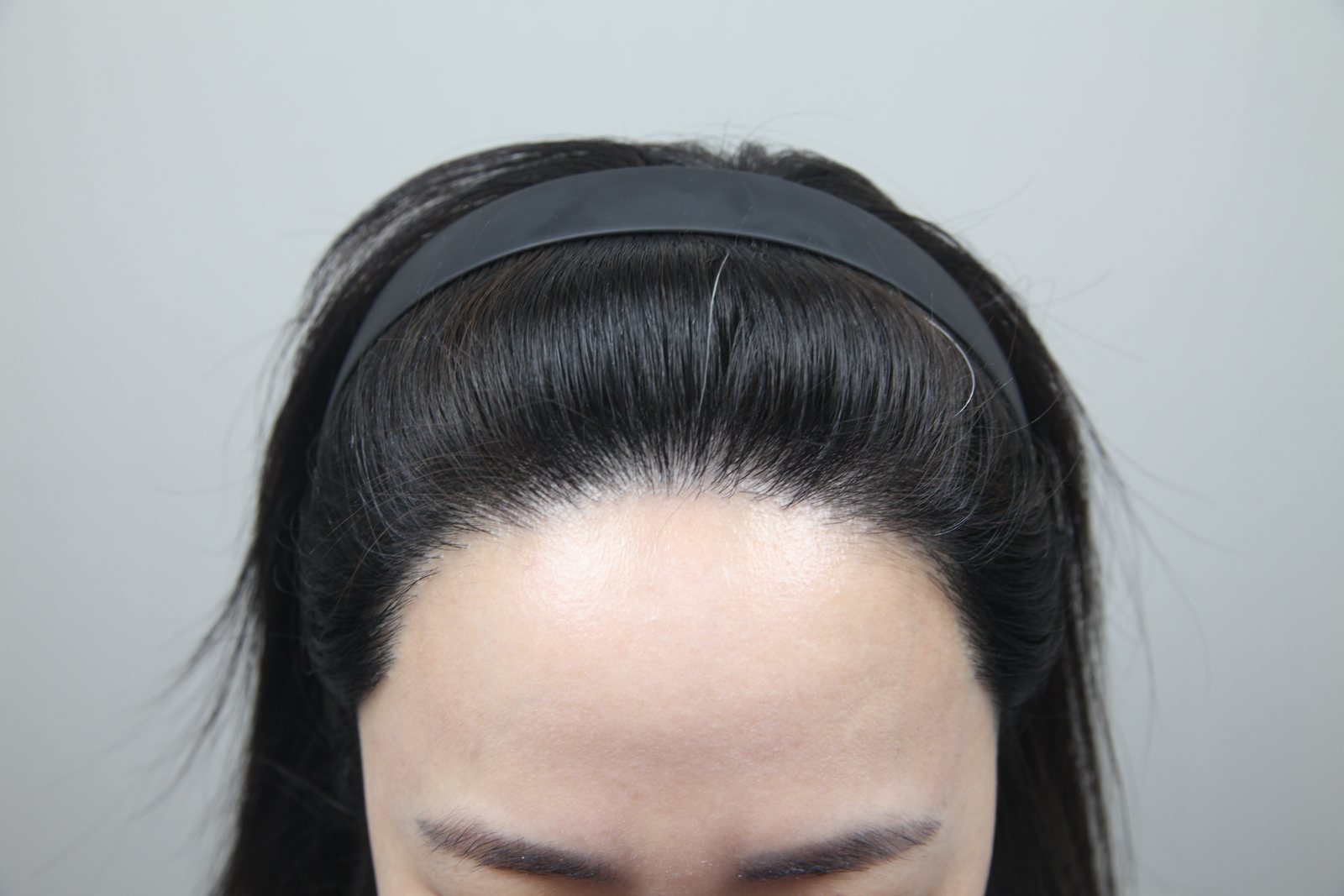 Non-Shaven FUE at MONARA Dermatology Clinic — after, case 3