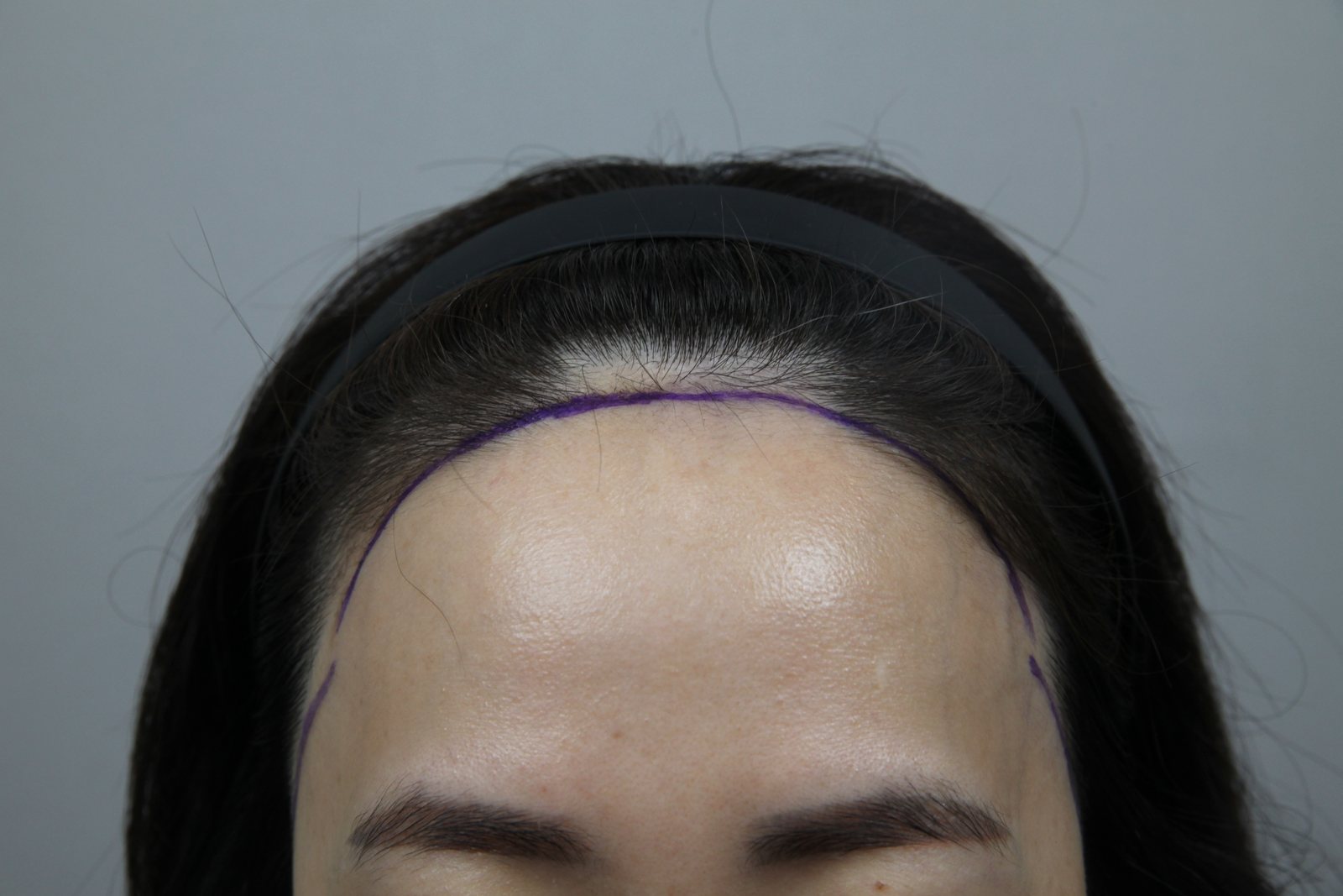 Non-Shaven FUE at MONARA Dermatology Clinic — before, case 3