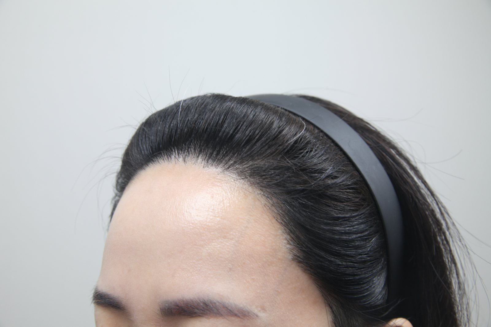 Non-Shaven FUE at MONARA Dermatology Clinic — after, case 4