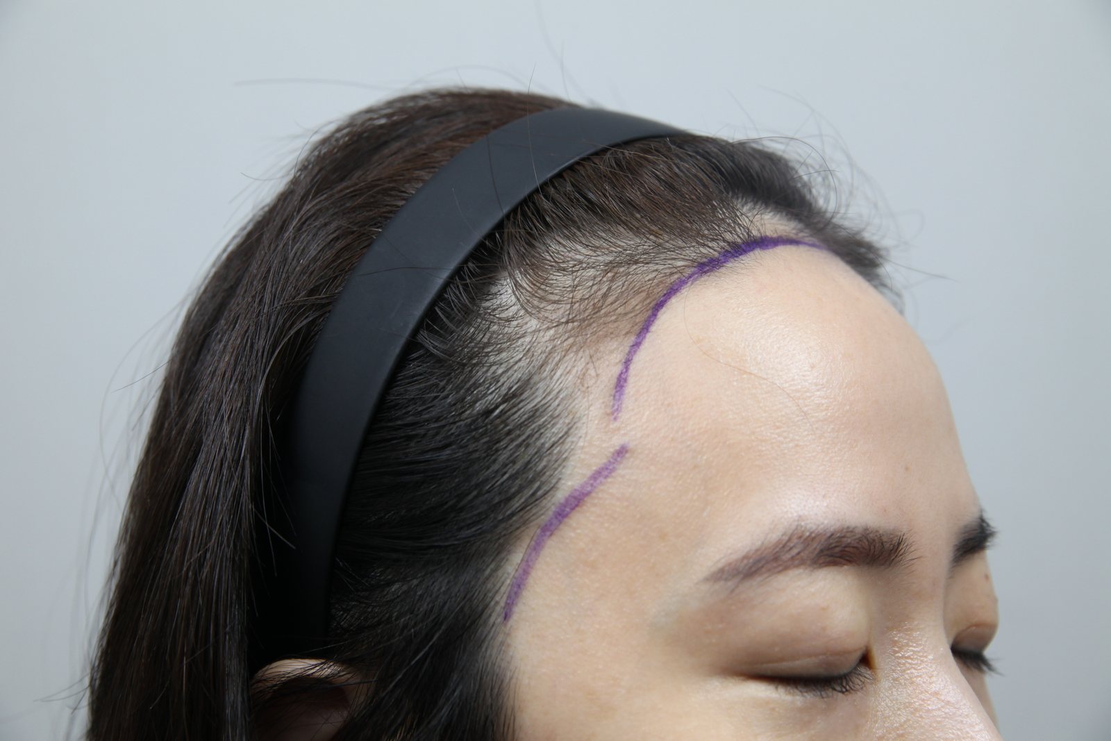 Non-Shaven FUE at MONARA Dermatology Clinic — before, case 4