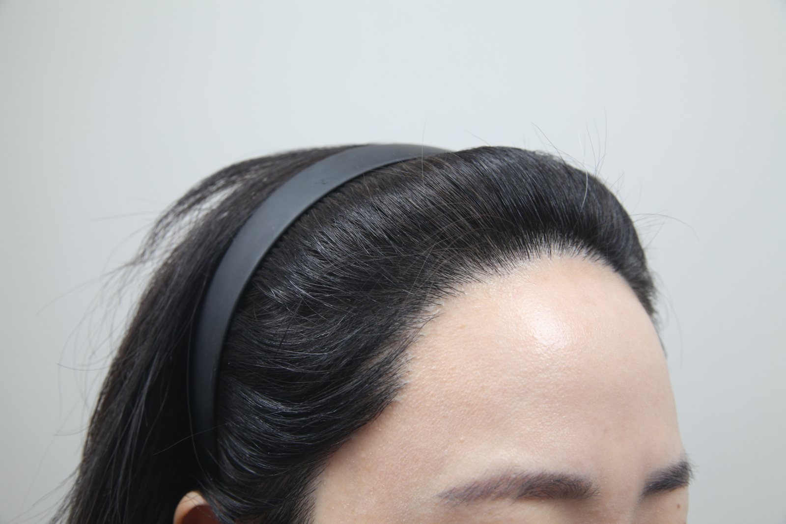 Non-Shaven FUE at MONARA Dermatology Clinic — after, case 5