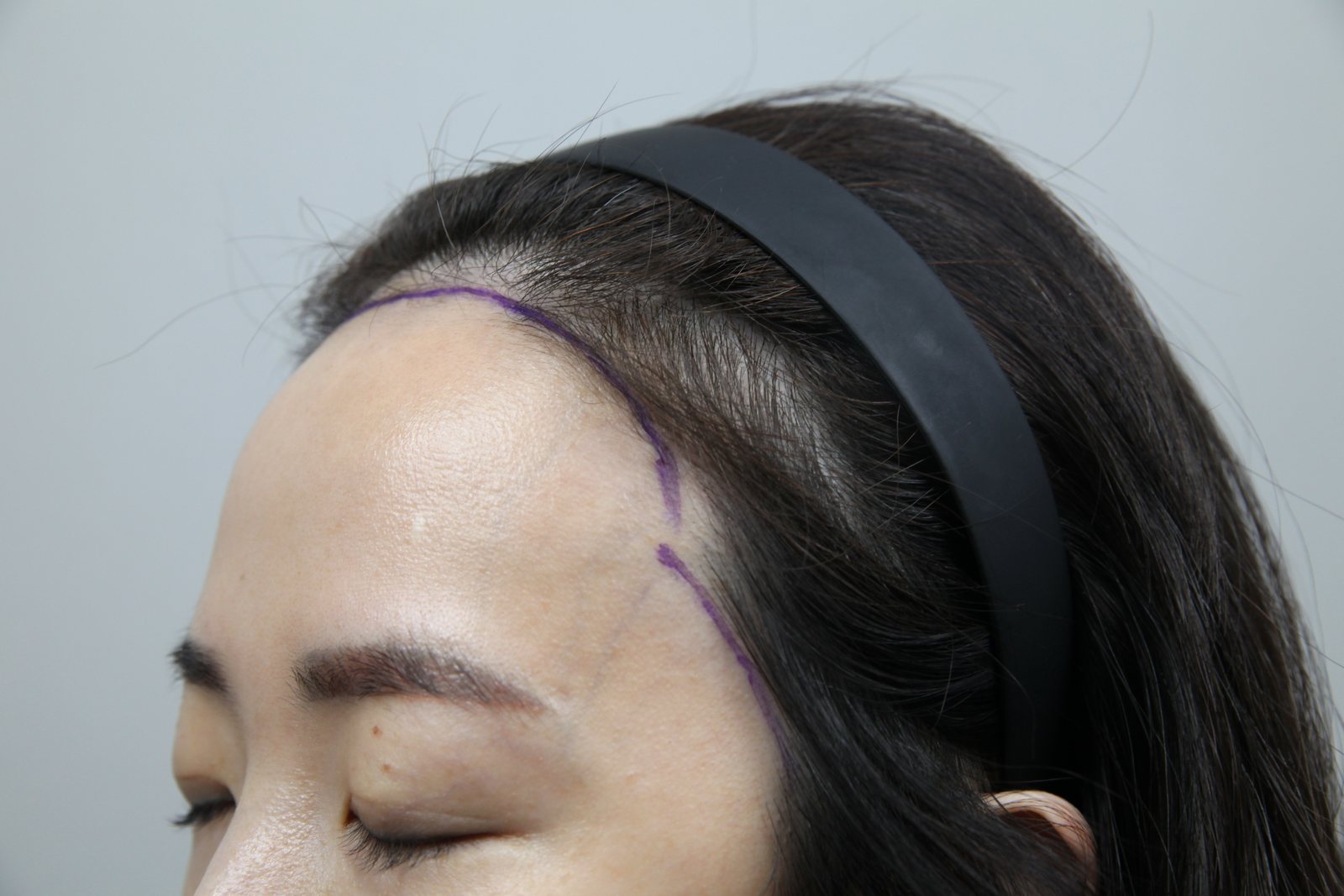 Non-Shaven FUE at MONARA Dermatology Clinic — before, case 5